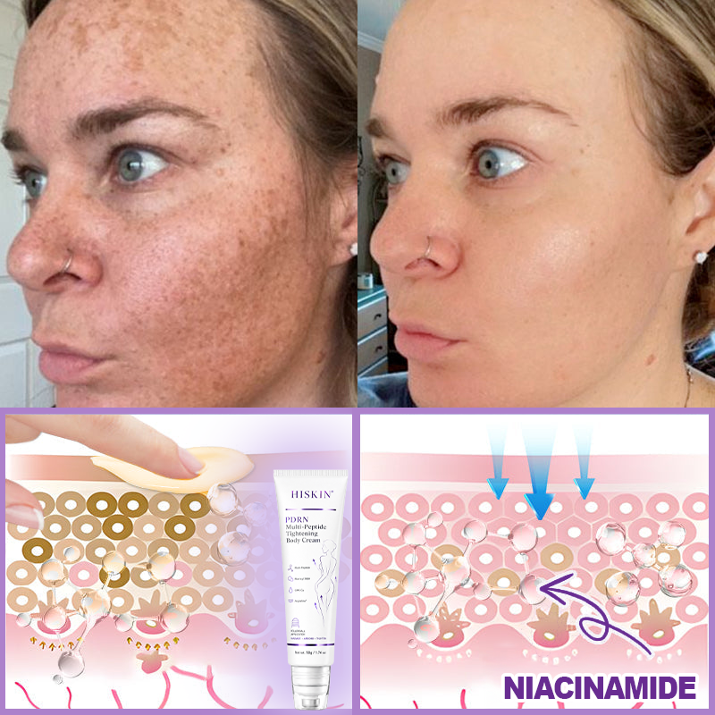 𝐇𝐈𝐒𝐊𝐈𝐍® 𝐏𝐃𝐑𝐍 𝐌𝐮𝐥𝐭𝐢-𝐏𝐞𝐩𝐭𝐢𝐝𝐞 𝐌𝐚𝐬𝐬𝐚𝐠𝐢𝐧𝐠 𝐁𝐨𝐝𝐲 𝐑𝐨𝐥𝐥𝐞𝐫 𝐂𝐫𝐞𝐚𝐦- 𝐀𝐧𝐭𝐢-𝐚𝐠𝐢𝐧𝐠, 𝐇𝐲𝐝𝐫𝐚𝐭𝐢𝐧𝐠, 𝐒𝐤𝐢𝐧 𝐅𝐢𝐫𝐦𝐢𝐧𝐠 & 𝐋𝐢𝐟𝐭𝐢𝐧𝐠, 𝐒𝐤𝐢𝐧 𝐑𝐞𝐩𝐚𝐢𝐫, 𝐄𝐯𝐞𝐧 𝐓𝐨𝐧𝐞, 𝐀𝐜𝐧𝐞 𝐚𝐧𝐝 𝐃𝐚𝐫𝐤 𝐒𝐩𝐨𝐭 𝐓𝐫𝐞𝐚𝐭𝐦𝐞𝐧𝐭, 𝐖𝐚𝐫𝐭 𝐚𝐧𝐝 𝐌𝐨𝐥𝐞 𝐑𝐞𝐦𝐨𝐯𝐚𝐥, 𝐚𝐧𝐝 𝐏𝐬𝐨𝐫𝐢𝐚𝐬𝐢𝐬 𝐑𝐞𝐥𝐢𝐞𝐟.